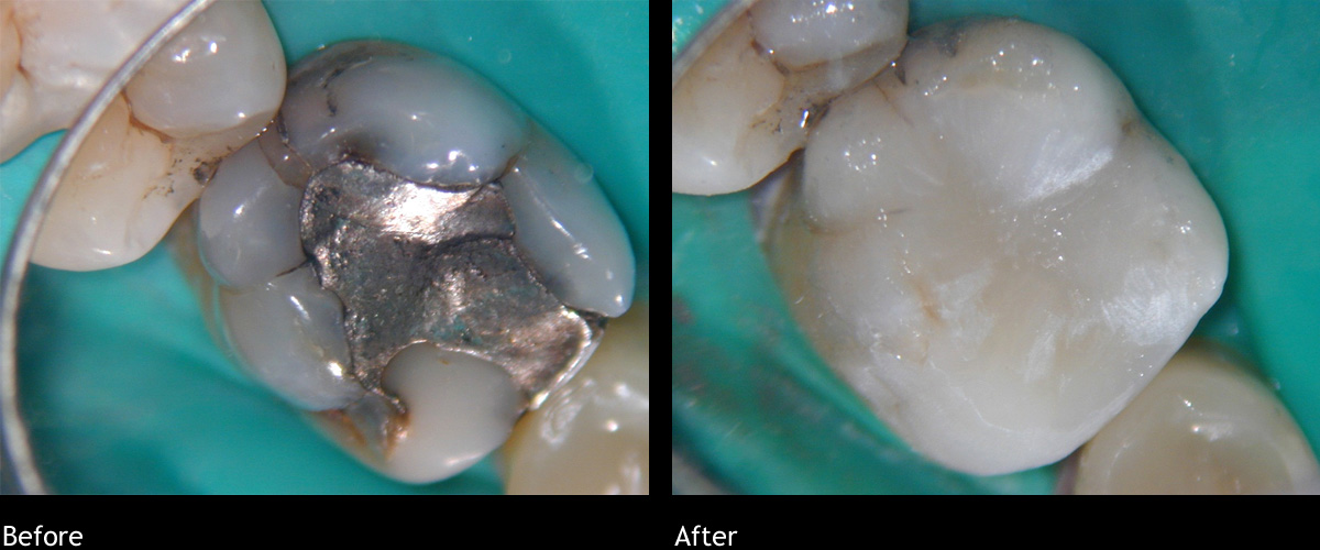 Amalgam Replacement Colonnade Dental Dr. Vincent How Dentist