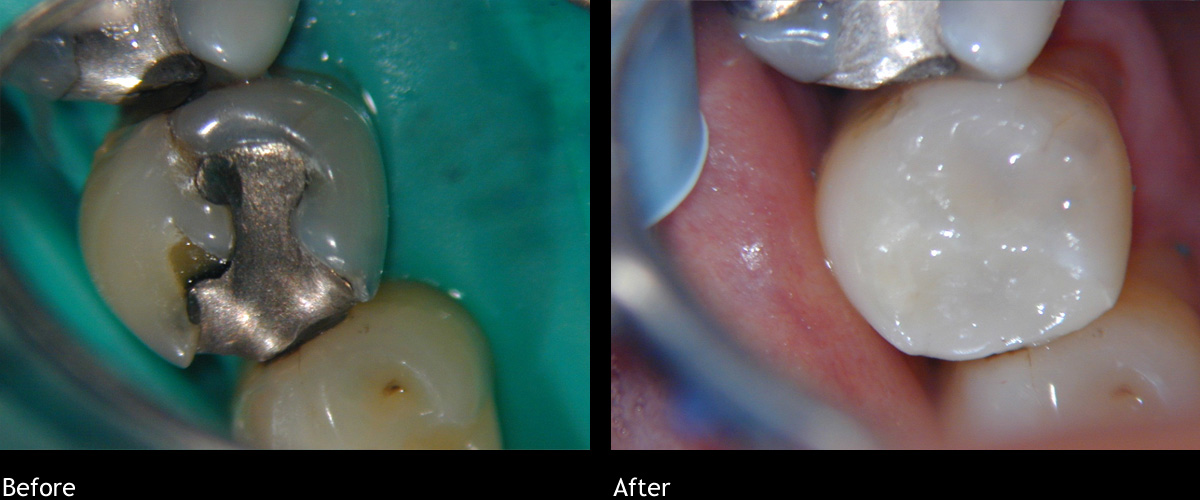 Amalgam Replacement Colonnade Dental Dr. Vincent How Dentist